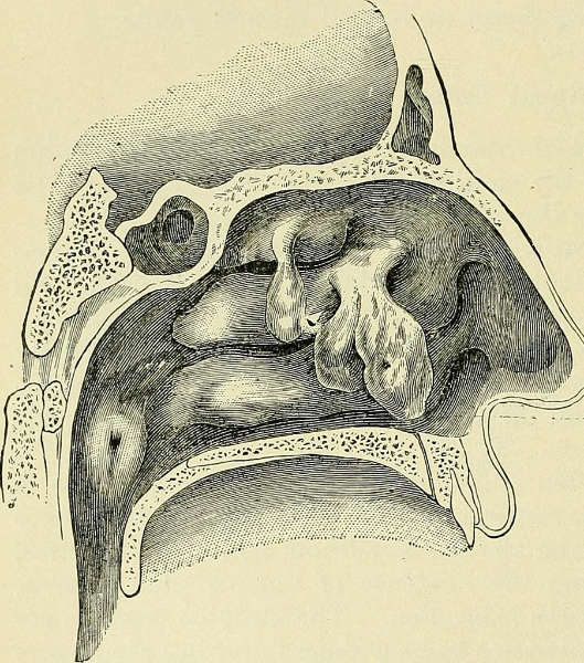 pólipo nasal